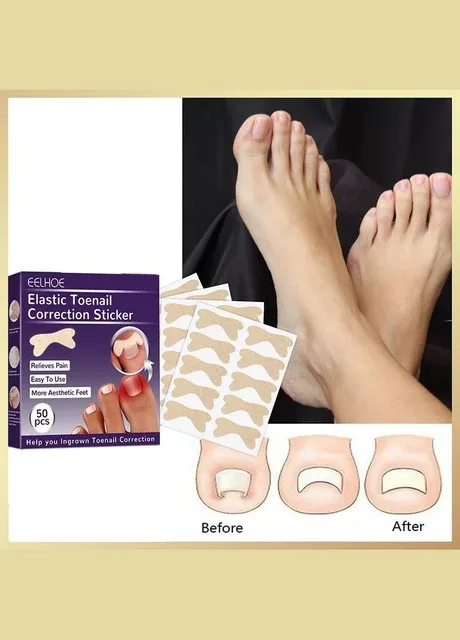 Набір пластирів Elastic Toenail Correction Sticker для вростаючих нігтів (50 шт) No Brand (316108951)